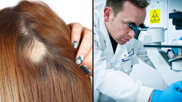 New Trials For Alopecia Treatment Are A Success, According To Study