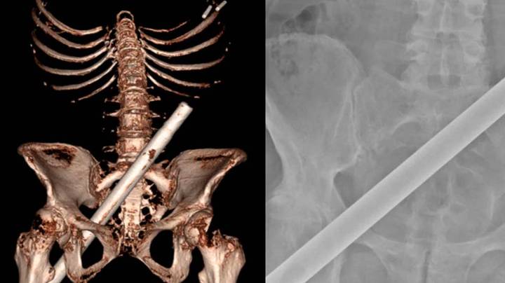 Shocking CT scans show how woman was impaled by Christmas tree