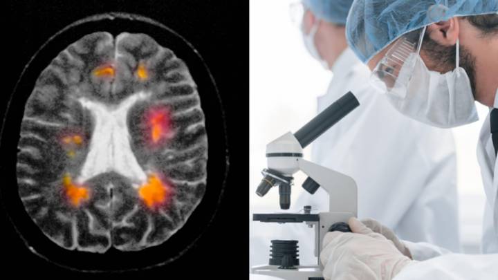 Scientists Believe They've Discovered Mystery Cause Of Multiple Sclerosis