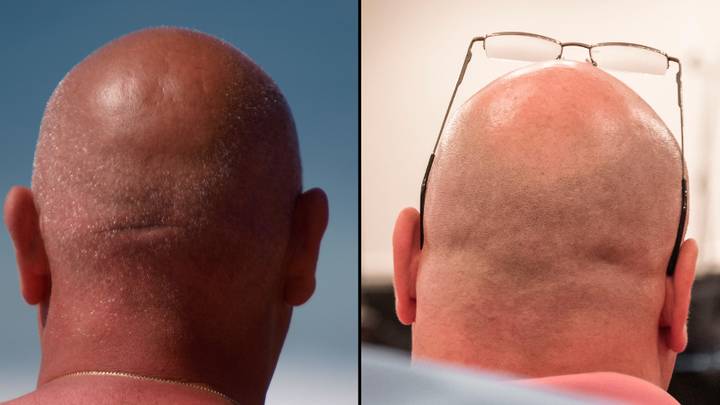 Scientists Have Discovered A Potential Cure For Baldness