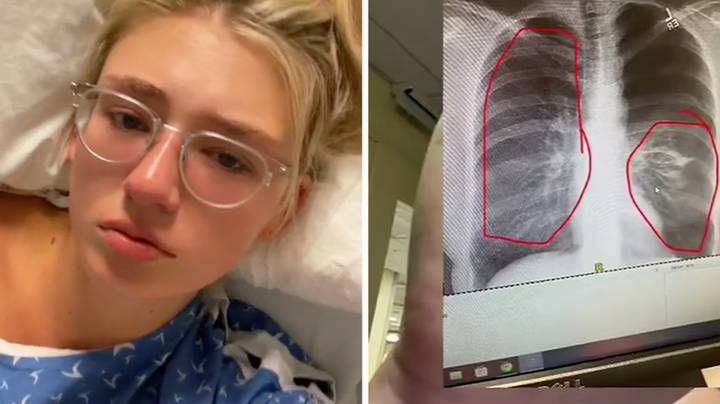 Woman Shares Stark Vaping Warning After She Was Rushed To Hospital With Collapsed Lung