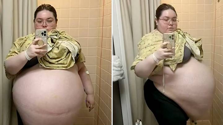 Woman 'feels like a person again' after having 100lbs ovarian cyst the size of an exercise ball removed