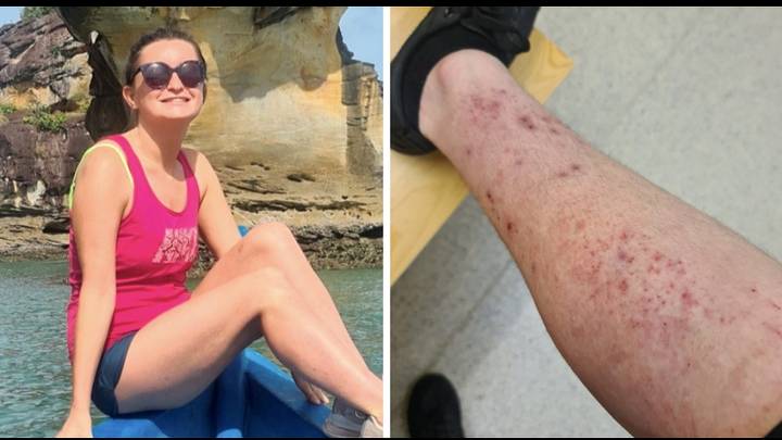 Woman says miracle drug cured eczema that left her bed bound for decades