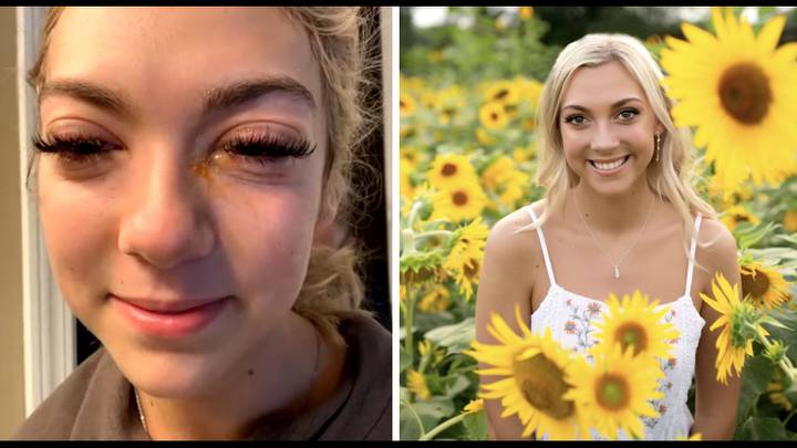 Woman left looking like a 'zombie' after horror allergic reaction to lash extensions