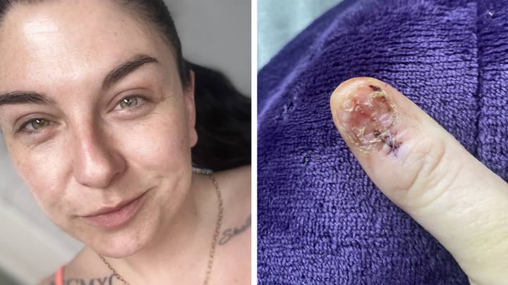 Mum diagnosed with cancer after mistaking mark on her fingernail for a bruise