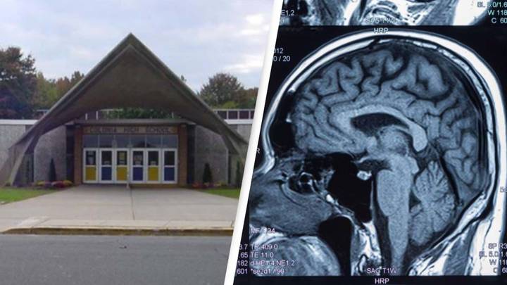 Extremely Rare Brain Tumours Linked To 65 People From Same School