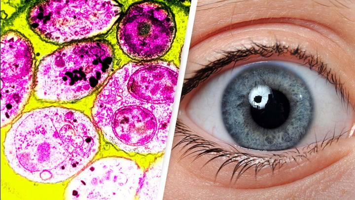 Parasite That Attacks The Retina Is Infecting One In Three People