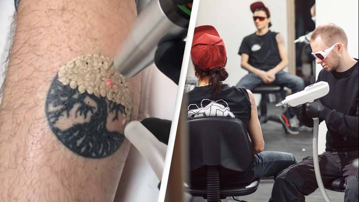 People are discovering the gross way tattoo ink leaves your body when you get laser removal