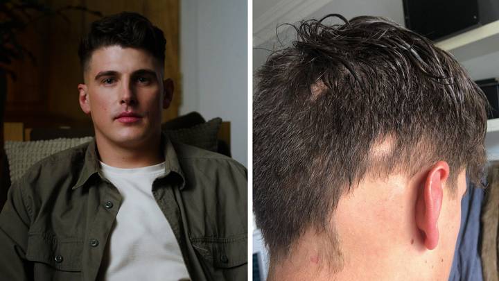 Lad lost chunks of hair and developed skin condition through stress of gambling