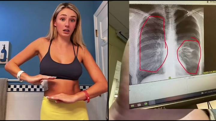 Student Issues Urgent Warning To People Who Vape After She's Hospitalised With Collapsed Lung