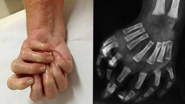 Rare ‘mirror hand’ syndrome causes one hand to be completely symmetrical