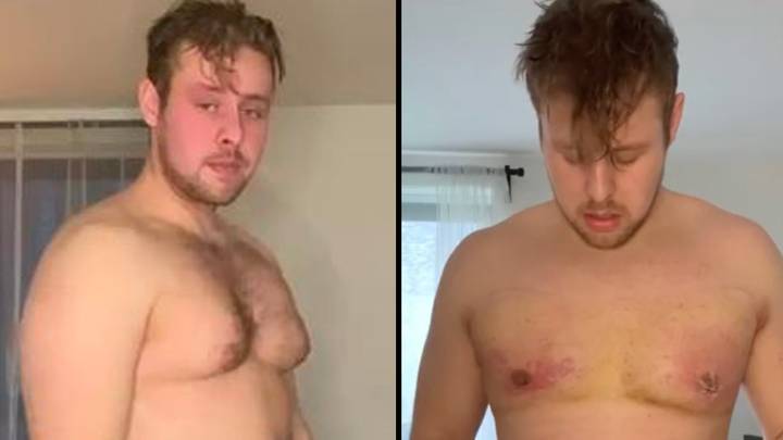 Bodybuilder Gets Surgery To Remove 'Boobs' That Developed When He Took Steroids