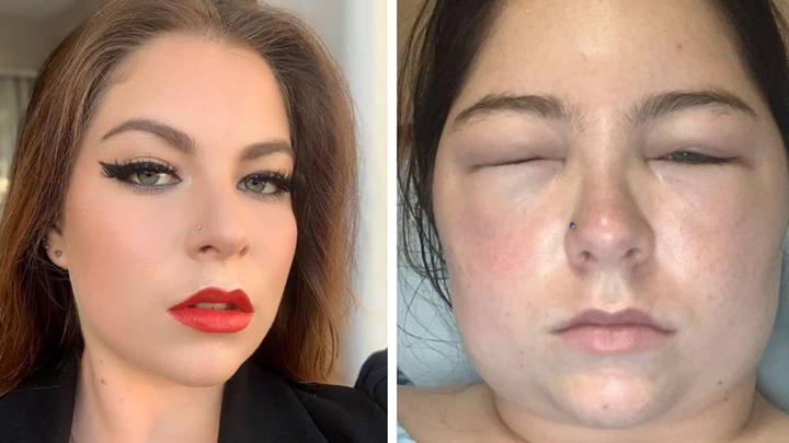 Woman says she nearly died after severe allergic reaction to hair dye