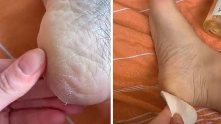 People Are Using Glycolic Acid On Their Feet