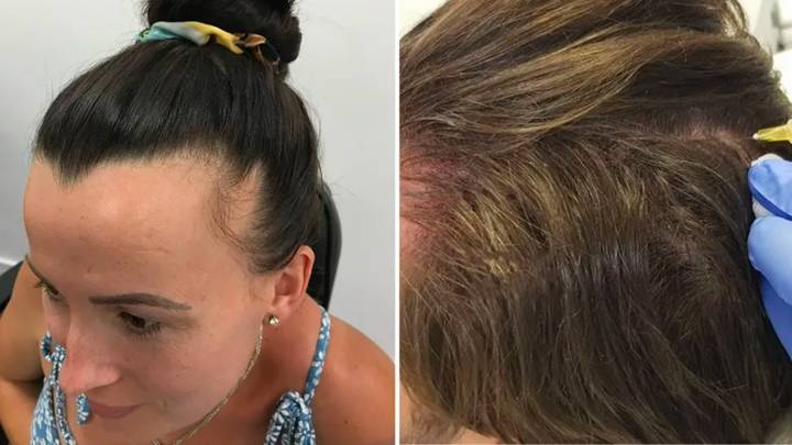 Mum whose grief made her hair fall out regains confidence after miracle procedure