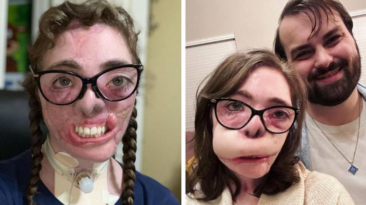 Woman who had most of her face torn off by two dogs shows off reconstructive surgery results