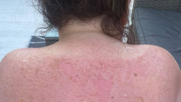Woman Left With Horrific Sunburn Despite Using Factor 30