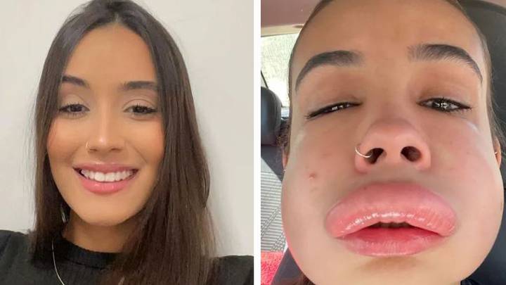 Woman ‘nearly died’ after getting lip filler