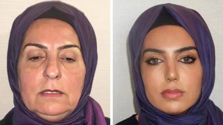 68-year-old woman shocks with before and after plastic surgery transformation