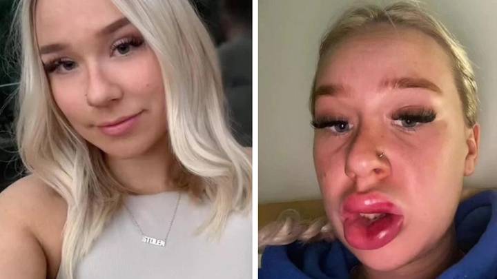 Woman shows how her lip fillers went badly wrong and people are shocked