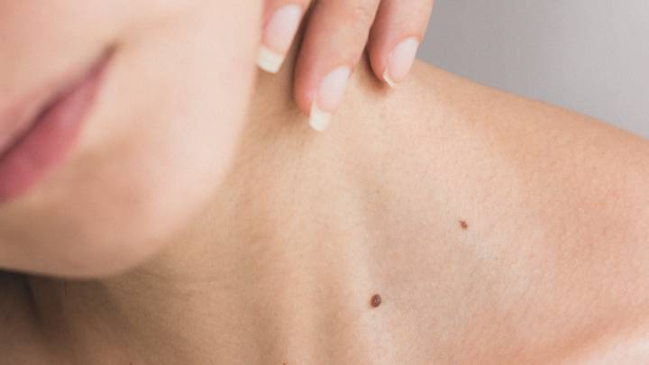 How To Spot A Cancerous Mole