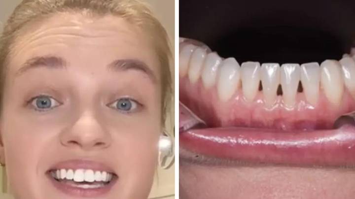 Dentist explains what it means if you have black triangles between your teeth