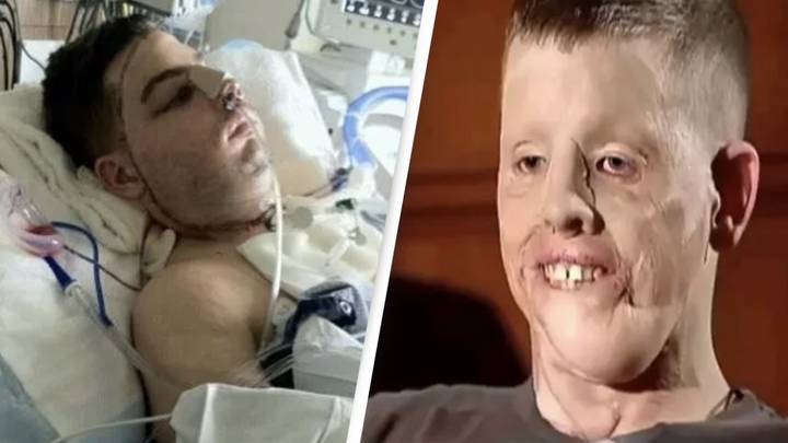 World’s Third Full Face Transplant Patient Says Operation ‘Best Decision’ Of His Life
