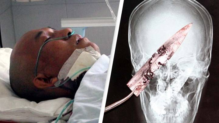 Man who'd suffered from headaches discovered he had rusty knife in head for four years
