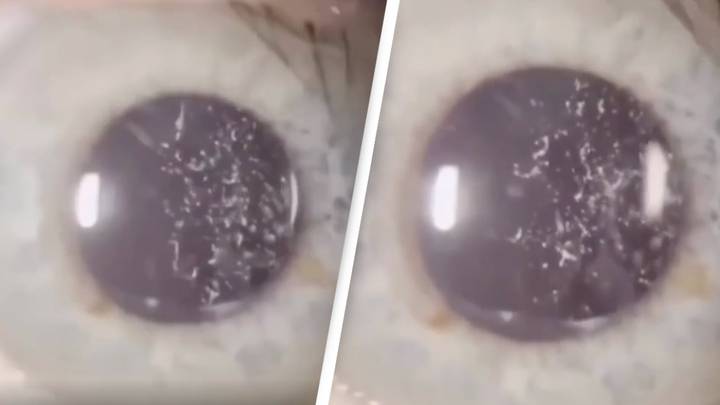 Condition which causes ‘tiny glittering particles’ inside eyes that most people don’t know they have