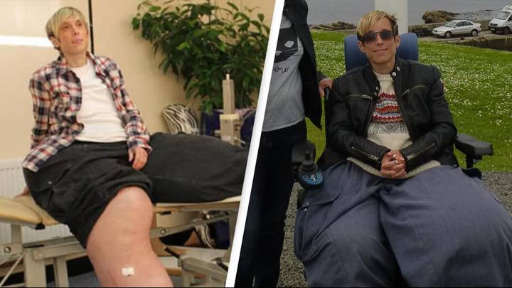Woman born with abnormally large legs had one amputated only for it to 'grow back'
