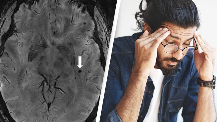 Never-seen-before spaces in brain could unlock key to treating migraines