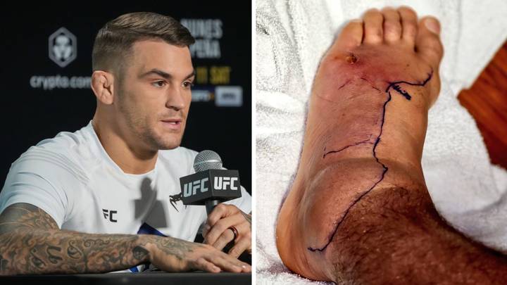 Dustin Poirier shows off gruesome looking foot as he battles infection in hospital
