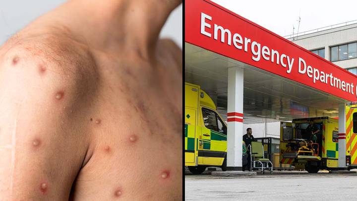 New strain of Monkeypox detected in the UK