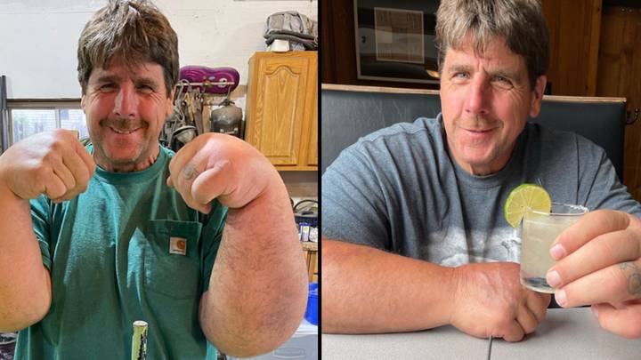 Mystery of man born with absolutely massive arms and hands has never been solved