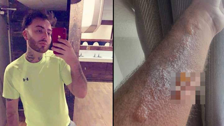 Lad 'could have been killed' after hair dye patch test left him with third degree burns