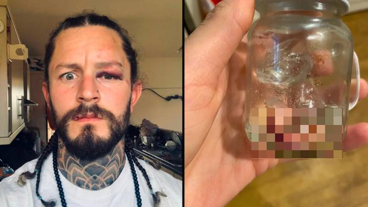 Bloke keeps own ear in pickle jar after it was bitten off in brutal UK ‘fight club’