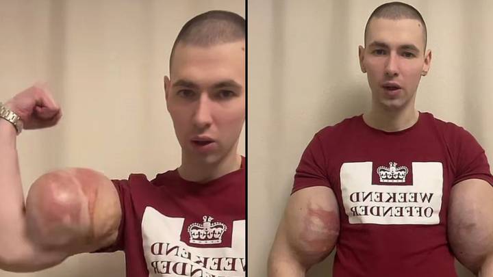 'Russian Popeye' Is Concerning Fans With Footage Of Him Flexing Jelly Injected Arms