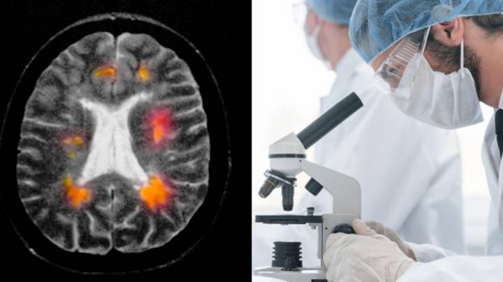 Scientists Believe They've Discovered Mystery Cause Of Multiple Sclerosis