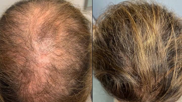 Old medicine that costs pennies can restore hair loss, doctors find