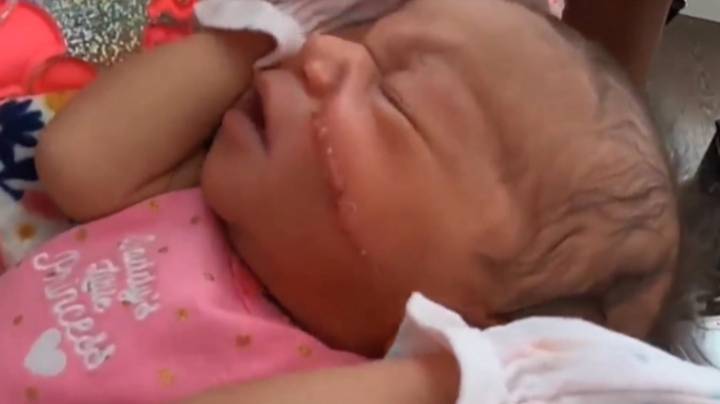 Baby Left With Huge Cut Across Her Face After C-Section