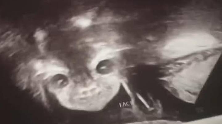 Pregnant Mum Shocked As Scan Reveals 'Devil Baby' Staring Back At Her