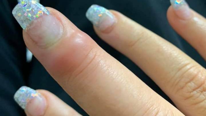 Woman's Finger Pops And Oozes With Puss After Trip To Nail Salon