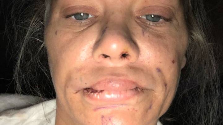 Woman Left With Lumpy Lips And 'Piggy Snout' After Surgery Goes Wrong