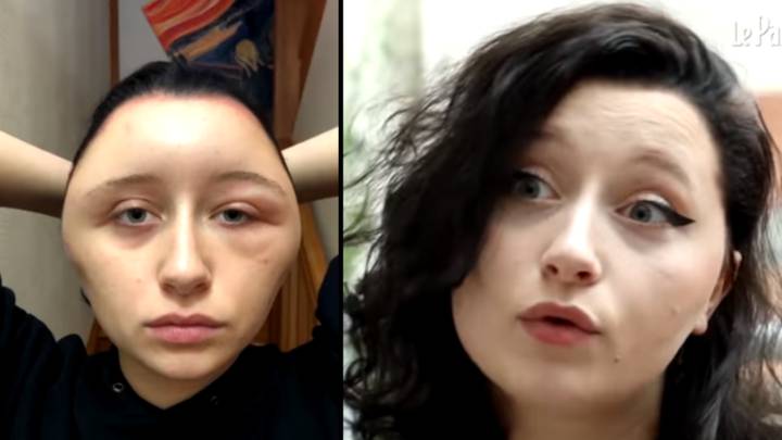 Woman's Head Swells After Extreme Allergic Reaction To Hair Dye