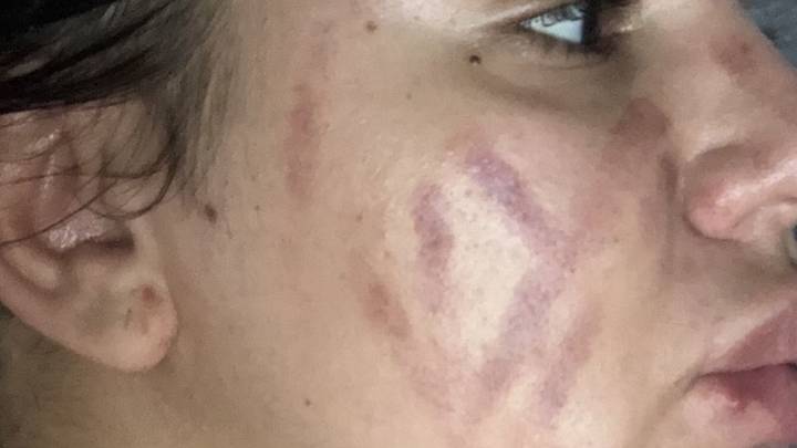 Student Left With Severe Bruises After Using Blackhead Remover