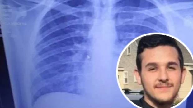 Shocking X-ray Shows Teen's Lungs Filled With 'Solidified Oil From Vaping' 