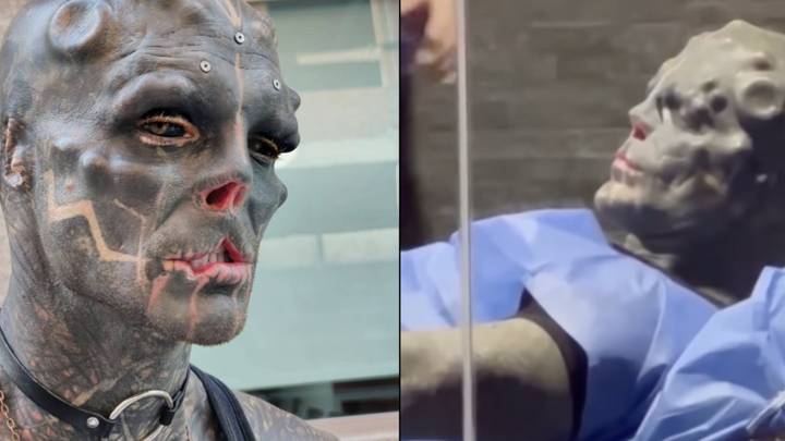 Man Who Has Transformed Himself Into 'Black Alien' Has Two Healthy Fingers Amputated