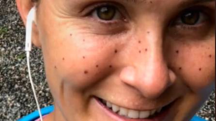 Woman Has To Get Laser Removal After Freckle Tattoos Go Horribly Wrong