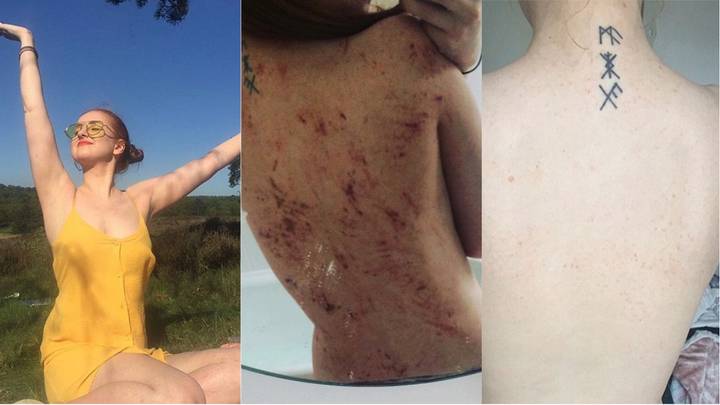 ​Going Vegan Leaves Woman Completely Eczema Free