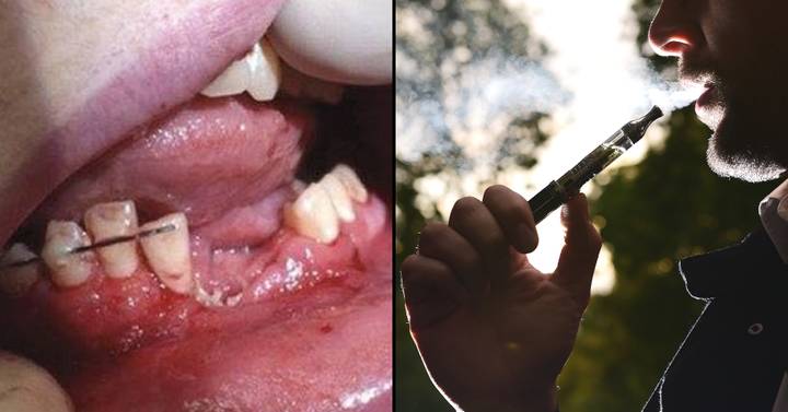 Vape Explodes In Teenager's Mouth Breaking Their Teeth 